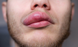 Опухшие губы