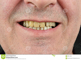 Гнилой зуб зубы - фото №2