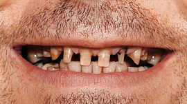 Зубы большие, черные, грязные - фото №1