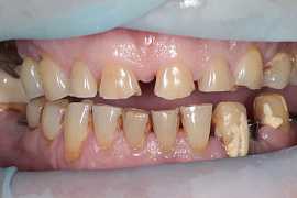 Исчезновение зубов - фото №1