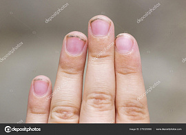 Пальцы грязные, больные - фото №1