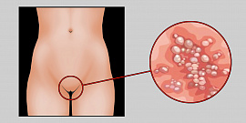 Гипертрофированные половые органы - фото №3